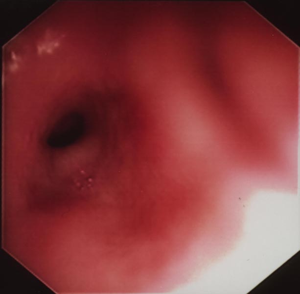 Stomach: pylorus normal 01 - gastroscopy