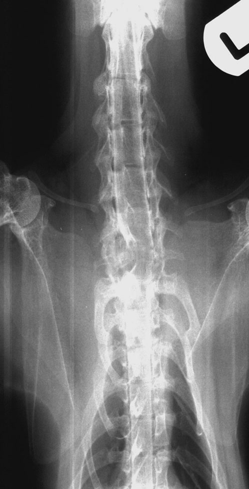 Spine: cervical cord compression - myelogram