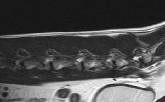 Spine: lumbar normal anatomy 01 (parasagittal T2W) MRI