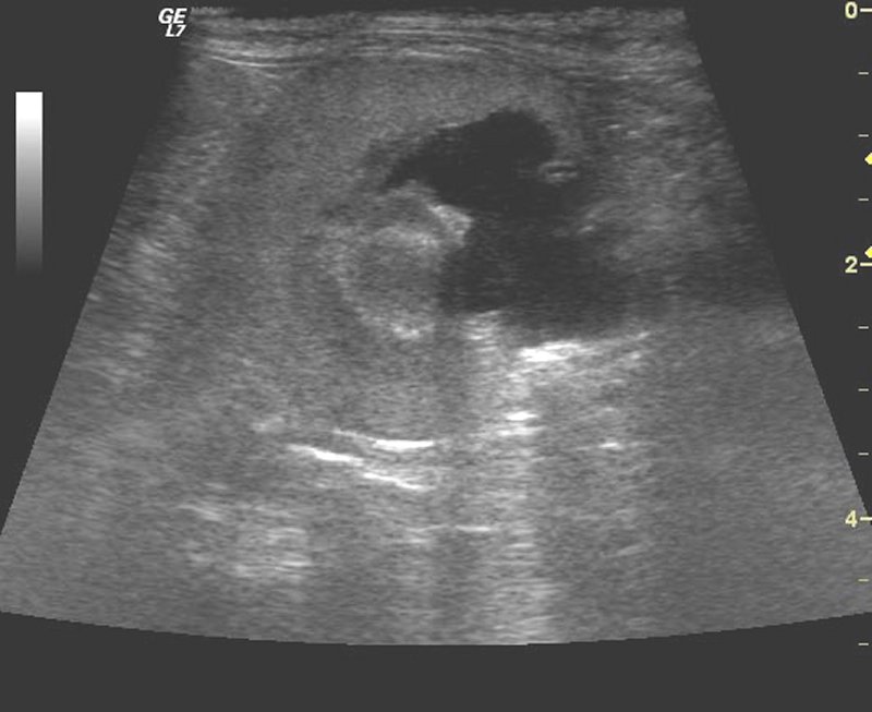 Kidney: hydronephrosis - ultrasound