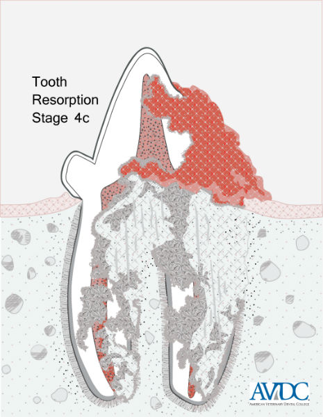 Tooth resorption: stage 4c - diagram
