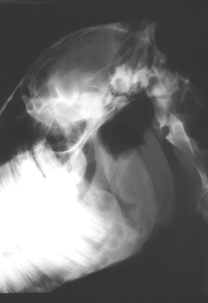 Pharynx: retropharyngeal abscess 01 - LM radiograph