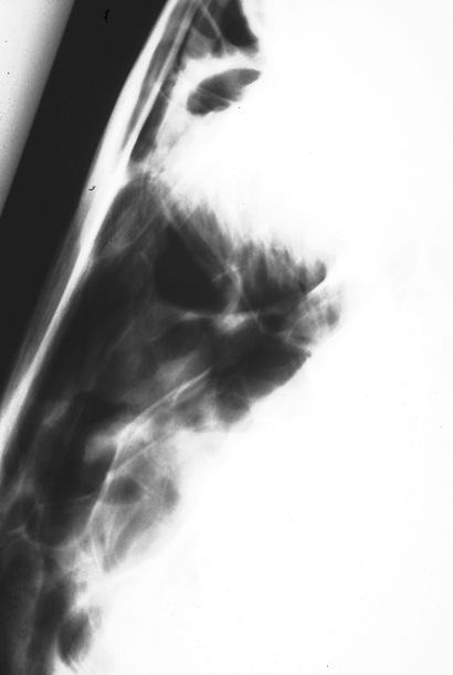 Ethmoid: hematoma 03 - LM radiograph