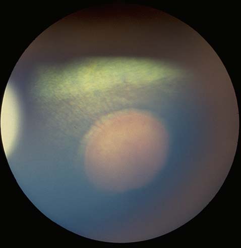Optic disk: papilledema - neuritis