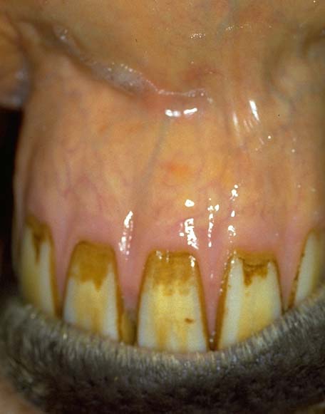 Mouth: icterus - gums