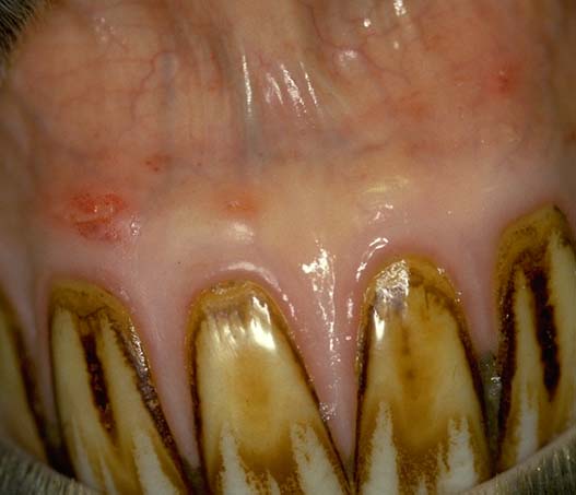 Oral mucosa: petechiation