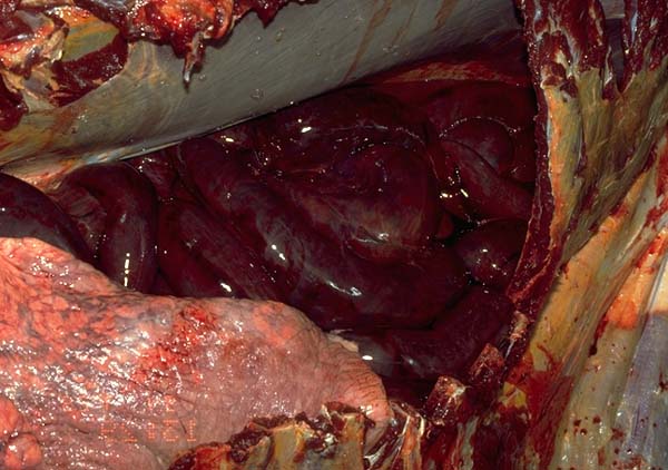 Diaphragm: hernia 03 - pathology