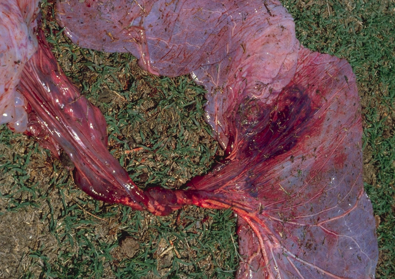 Placenta: hemorrhage - pathology