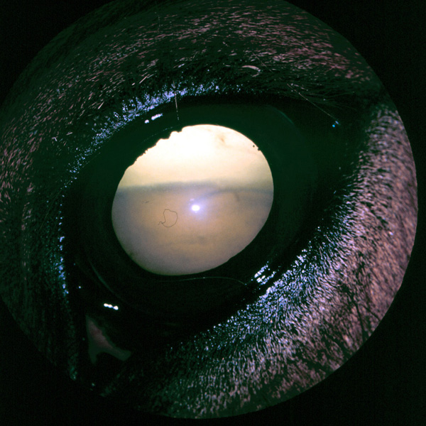 Eye: retinal detachment - acute uveitis