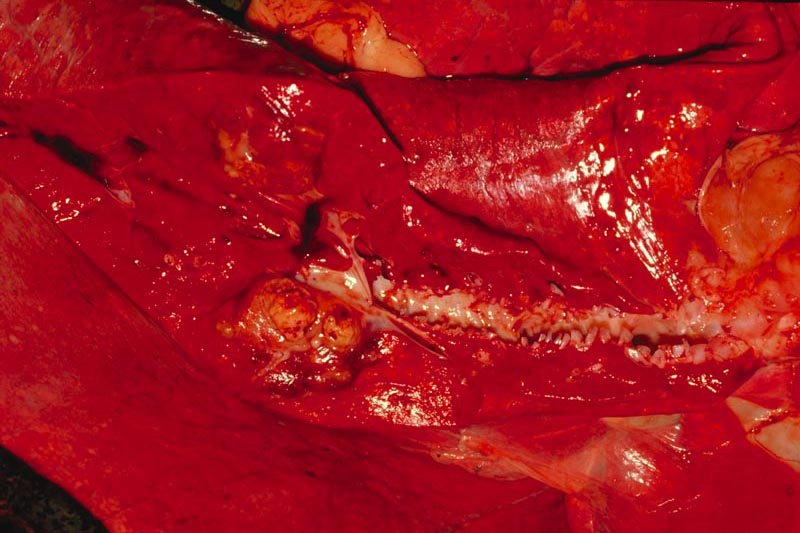 Lung: abscesses - pathology