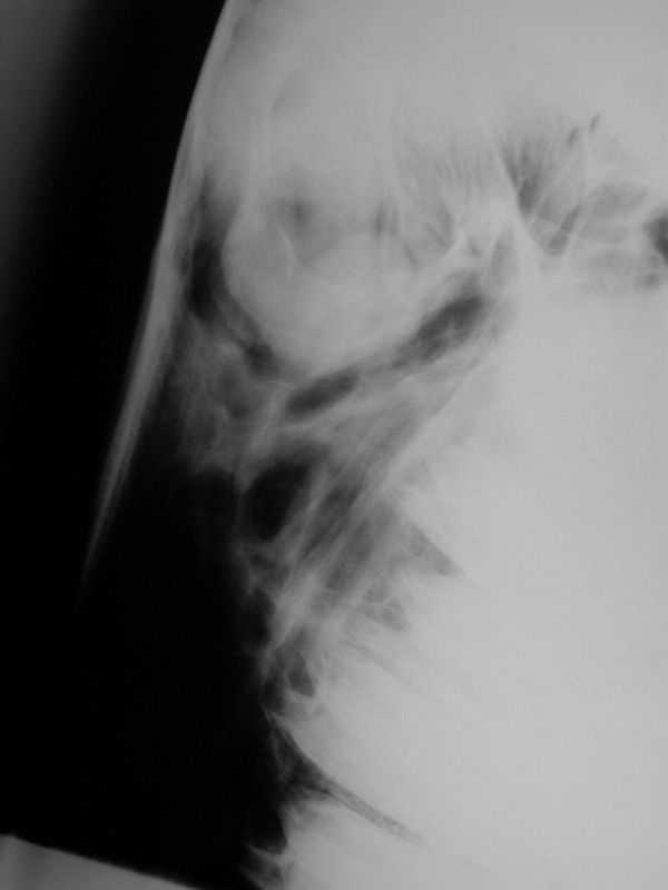 Ethmoid: hematoma 06 - LM radiograph