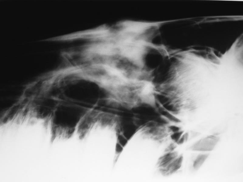 Head: nasal fracture - LM radiograph