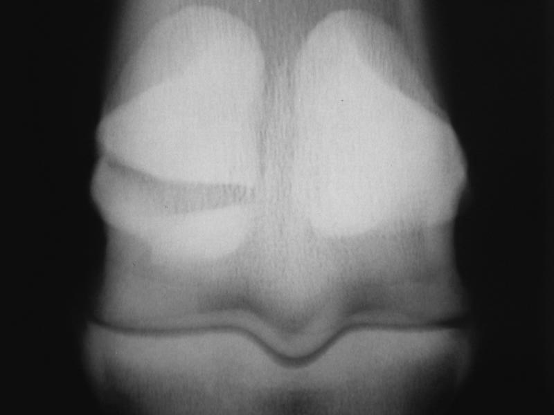 Proximal sesamoid: fracture 11 basal - DP radiograph