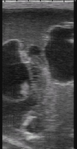 Reproduction: fetal sexing (abnormal) - ultrasound