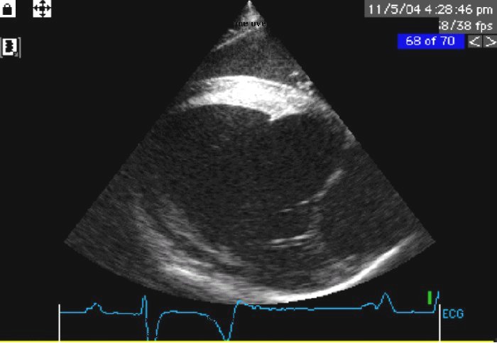 Heart: aortic regurgitation 07 - volume overload - echocardiograph