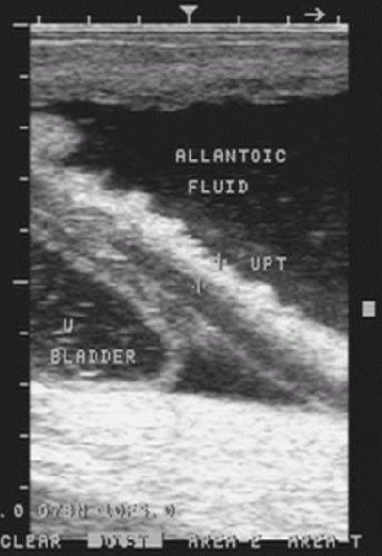 Placenta: utero-placental thickness - ultrasound