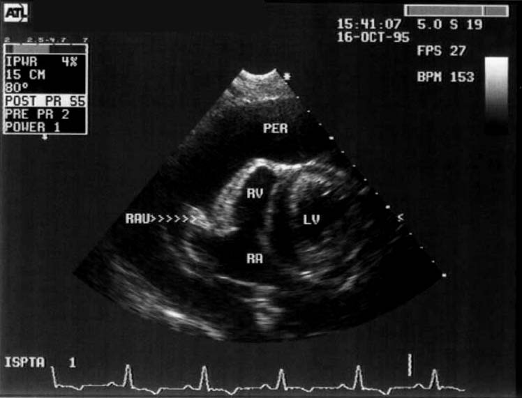 Heart pericardial effusion - 2-D ultrasound